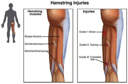 Hamstring injuries_Small