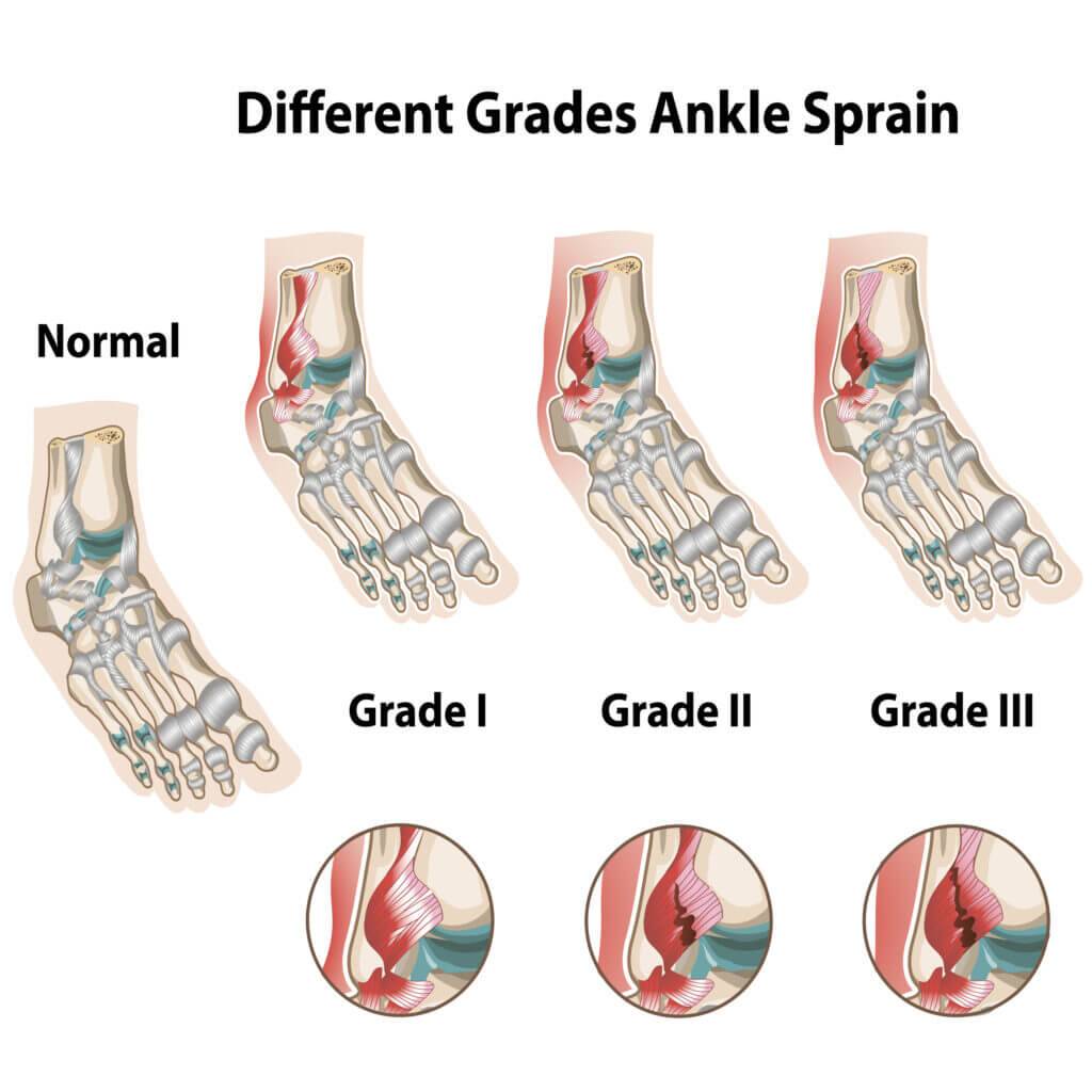Acute Ankle Sprain - Peak Performance Physiotherapy