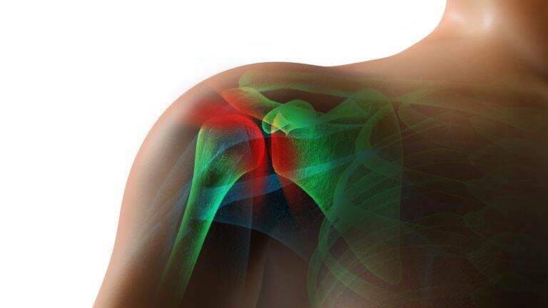 Shoulder Bursitis Pain